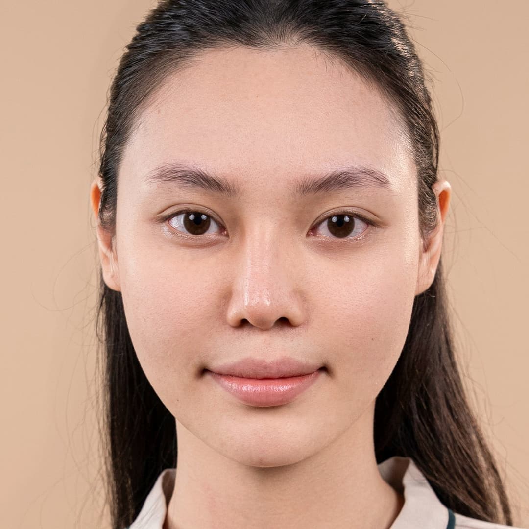 Patientin Lưu Phương Anh – vor dem Eingriff mit One-Fit-Nasenkorrektur