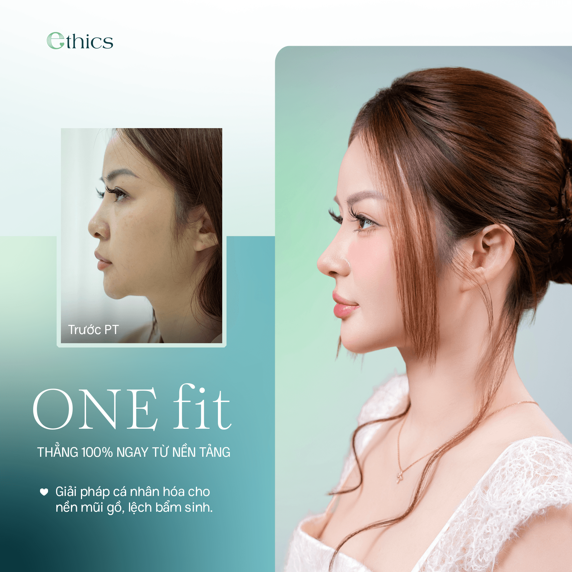 Nasenkorrektur mit der OneFit Premium Methode